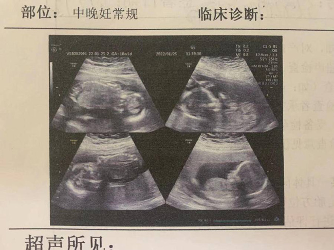 罕有！山东一孕妇怀四胞胎破费差距天： 两个早产，两个留腹中